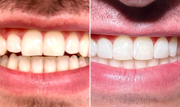 Zoom! Whitening