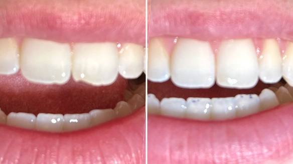 Resin Bonding