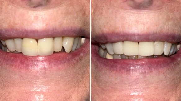 Veneer